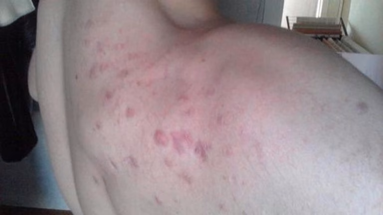 Co jest przyczyną występowania pryszczy w różnych miejscach na ciele?