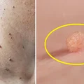Zastanawiasz się, czym są te krosty? Jak je leczyć i czy są groźne?