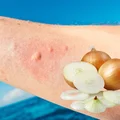 🐝 Cebula po użądleniu pszczoły lub osy – czy naprawdę działa? Oto, co mówi medycyna!