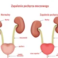 Lista 9 sposobów na wyleczenie zapalenia pęcherza
