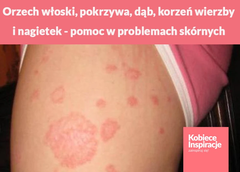 Orzech włoski, pokrzywa, dąb, korzeń wierzby i nagietek - Twoja pomoc w problemach skórnych