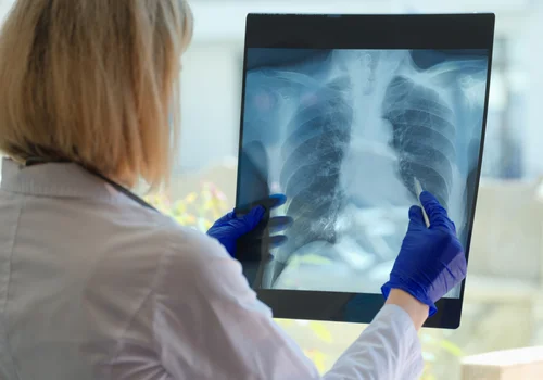 Światowy Dzień Gruźlicy: Walka z Jedną z Najstarszych Chorób Zakaźnych