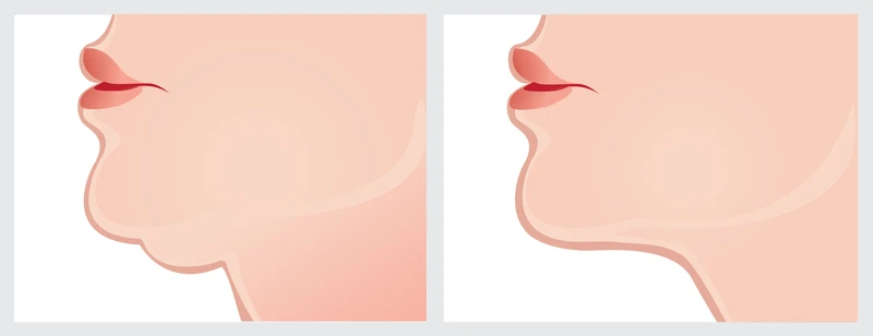 Zapobiegnij powiększaniu się drugiego podbródka za pomocą tych 7 produktów!