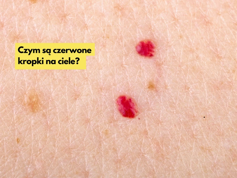 Takie czerwone kropki na ciele mogą pojawić się u Ciebie po 30, roku życia!