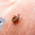 Test na boreliozę z kleszcza! Poznaj fakty i mity dotyczące tej metody!