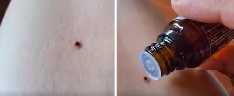 Usuwanie KLESZCZA przy pomocy OLEJKU MIĘTOWEGO? Lepiej tego nie rób!