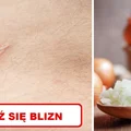 Wykorzystaj właściwości CEBULI i zmniejsz widoczność BLIZN!