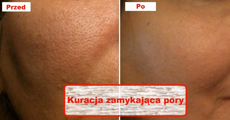 Wypróbuj kurację która zniweluje otwarte PORY