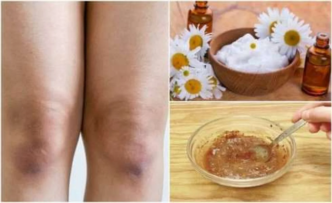 Jak rozjaśnić i wygładzić skórę na kolanach? 3 skuteczne sposoby