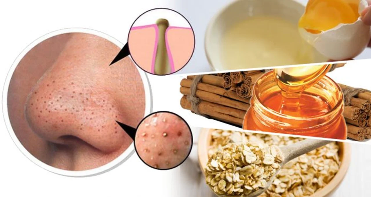 3 domowe sposoby na pielęgnację skóry trądzikowej