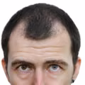 Jak zapobiec łysieniu?