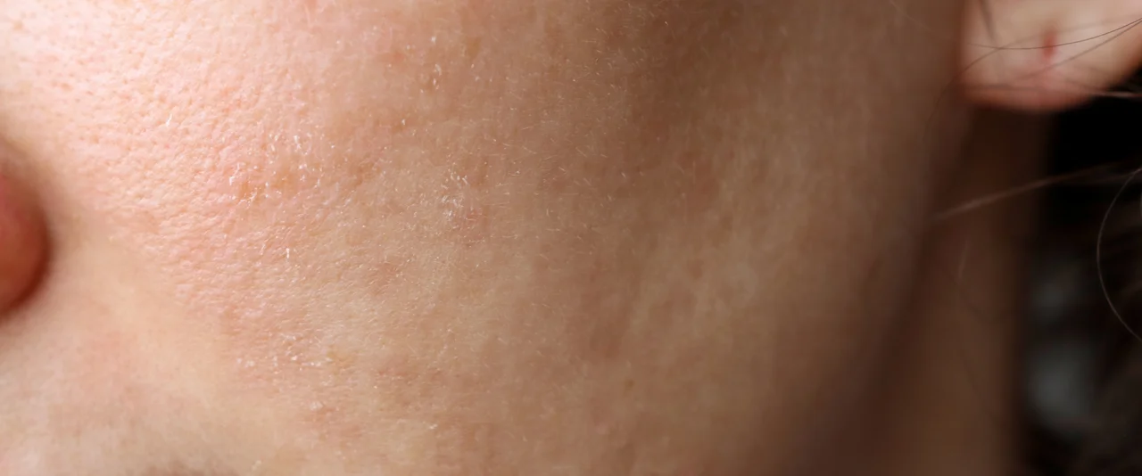Jak zadbać o atopową skórę?