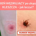 RUMIEŃ WĘDRUJĄCY po ukąszeniu KLESZCZA – jak leczyć?