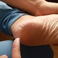 Pozbądź się suchych i popękanych pięt! Wystarczy pół szklanki i 15 minut a Twój problem zniknie!