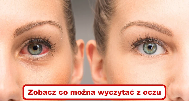 Co Twoje OCZY mogą powiedzieć o zdrowiu Twojego organizmu?