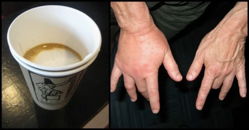 Pijesz dużo kawy? Zobacz jakie są objawy przedawkowania kofeiny!
