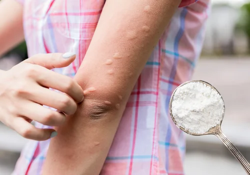 Ekspresowa maść z kuchni z 2 składników! Bąble po komarach natychmiast przestaną swędzieć