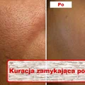 Wypróbuj kurację która zniweluje otwarte PORY