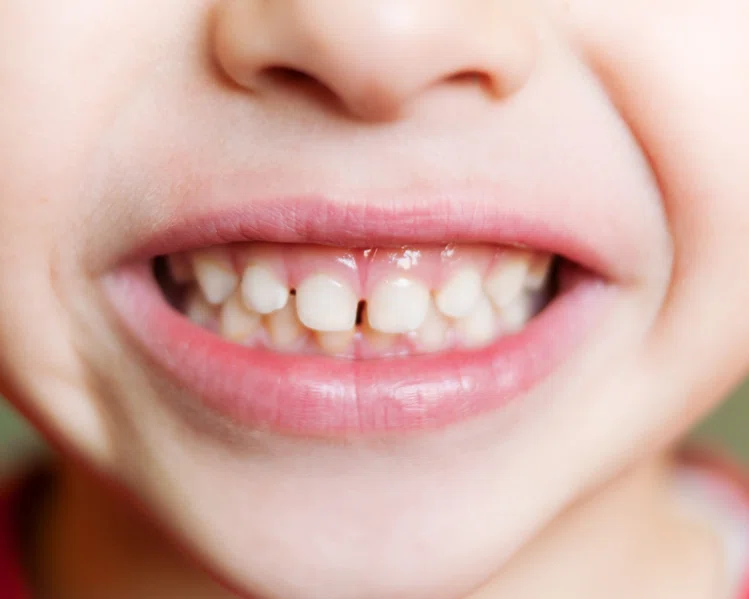 Zdjęcie Co może oznaczać zgrzytanie zębami u dzieci? #1