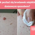 Jak pozbyć się brodawek miękkich domowym sposobem?