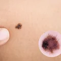 Jakie są ulubione miejsca czerniaka? Kiedy udać się do lekarza?