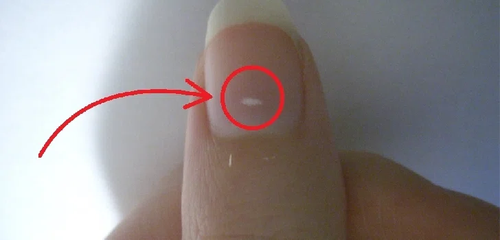 Zdjęcie O czym świadczą białe plamki na paznokciach? Sprawdź, czy sama ich nie masz! #1