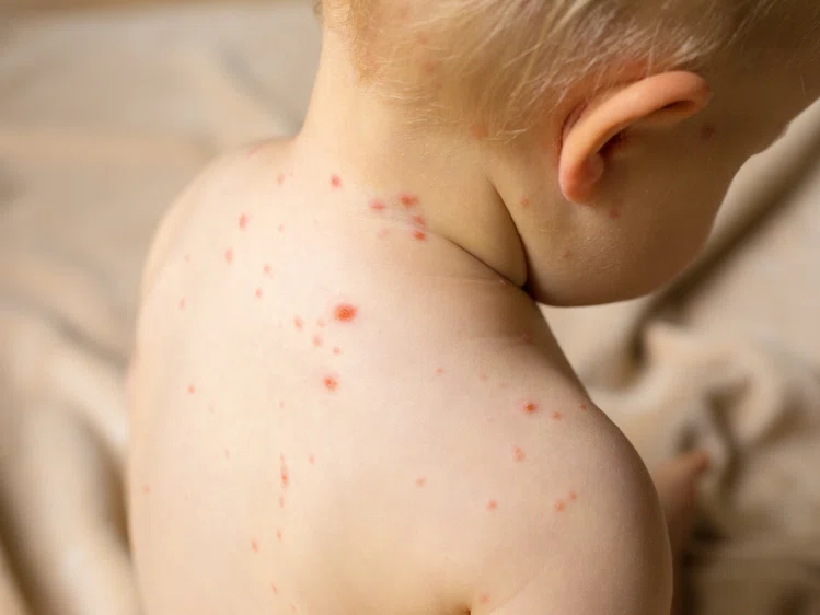 Zdjęcie Choroby zakaźne u dzieci - czym się objawiają, kiedy szczepić i jakie są powikłania? #2