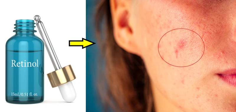 Kosmetyki z tym składnikiem działają cuda. Czy wiesz, czym jest retinol?