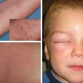 Wstrząs anafilaktyczny – ta wiedza może uratować życie!