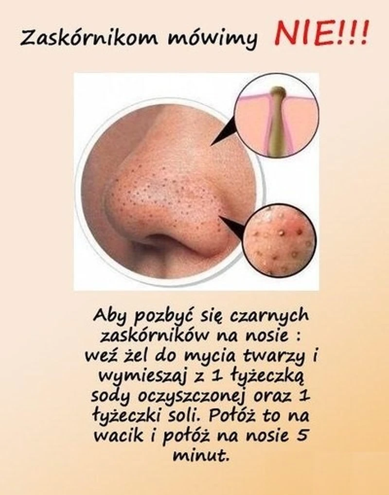 Jak pozbyć się zaskórników na nosie w szybki sposób!
