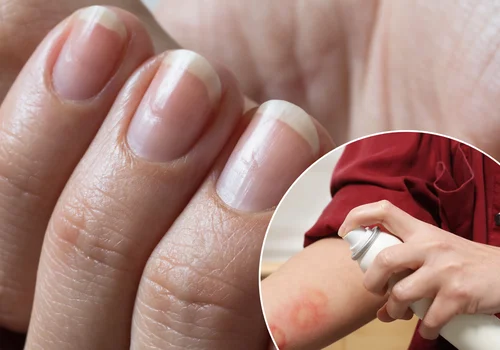 Ten preparat na oparzenia sprawia, że paznokcie rosną szybciej!