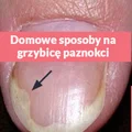 Domowe, skuteczne sposoby na leczenie grzybicy paznokci