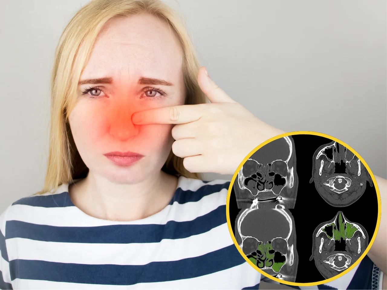 Masz ciągły katar? To mogą być polipy w zatokach – oto jak je rozpoznać