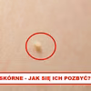 TAGI SKÓRNE – Zobacz jak się ich pozbyć