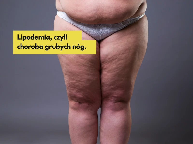 Lipodemia, czyli choroba grubych nóg. Jakie są przyczyny i jak ją leczyć?