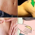 4 domowe sposoby na pozbycie się rozstępów!