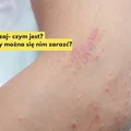 Masz takie znamię na skórze? Sprawdź czym jest liszaj i jak go wyleczyć?