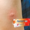 10 zastosowań Fenistil żelu. Działa bardzo szybko i przynosi znaczną ulgę.