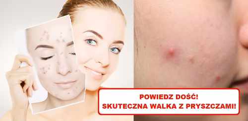 Dokuczają Ci PRYSZCZE? Wypróbuj domowe sposoby!