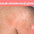 7 oznak nietolerancji glutenu