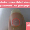 Co jest przyczyną białych plam na paznokciach? Nie ignoruj tego