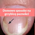 Domowe, skuteczne sposoby na leczenie grzybicy paznokci