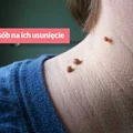 Każdy z Nas ma przynajmniej jednego - WŁÓKNIAKI - Jak je usunąć?