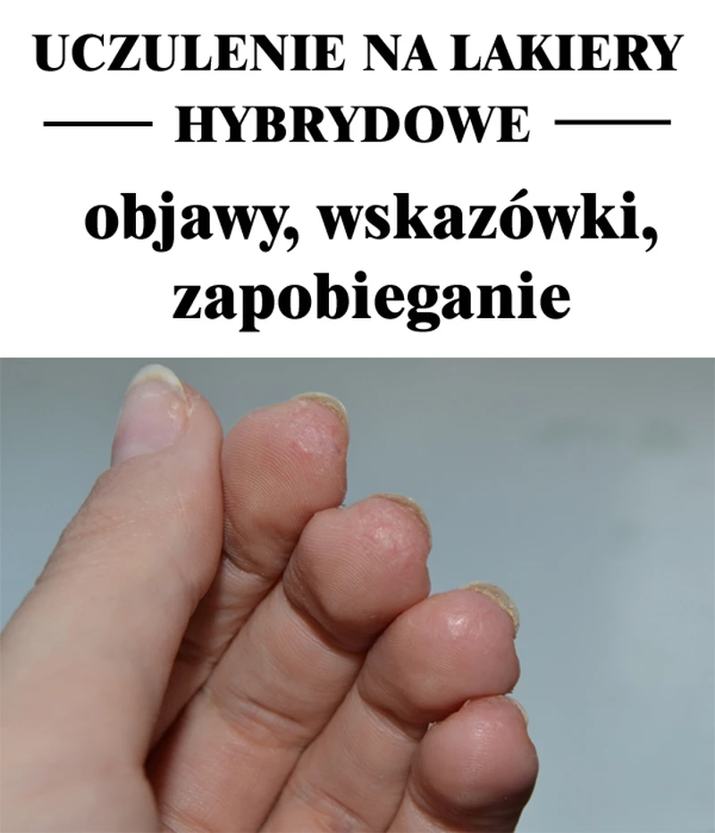 UCZULENIE NA HYBRYDĘ – objawy, wskazówki, zapobieganie