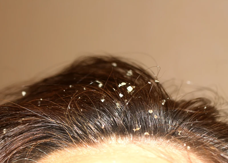 10 naturalnych i łatwych sposobów na pożegnanie łupieżu