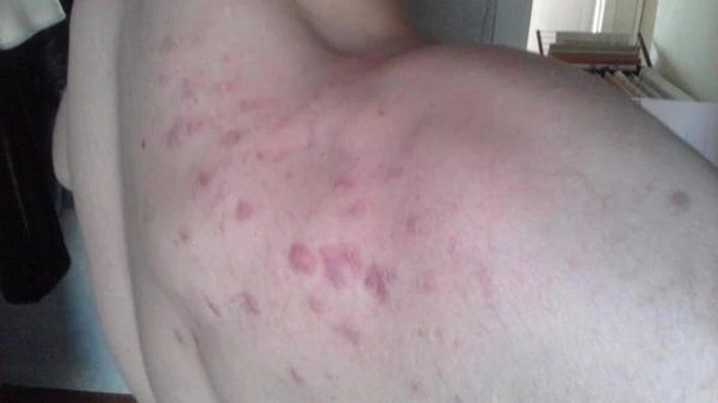 Co jest przyczyną występowania pryszczy w różnych miejscach na ciele?