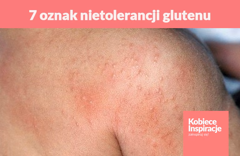 7 oznak nietolerancji glutenu