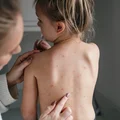 Wzrost zachorowań popularnej choroby wśród dzieci! Rodzice bądźcie czujni!
