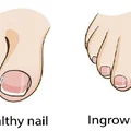 Pozbądź się problemu wrastającego paznokcia