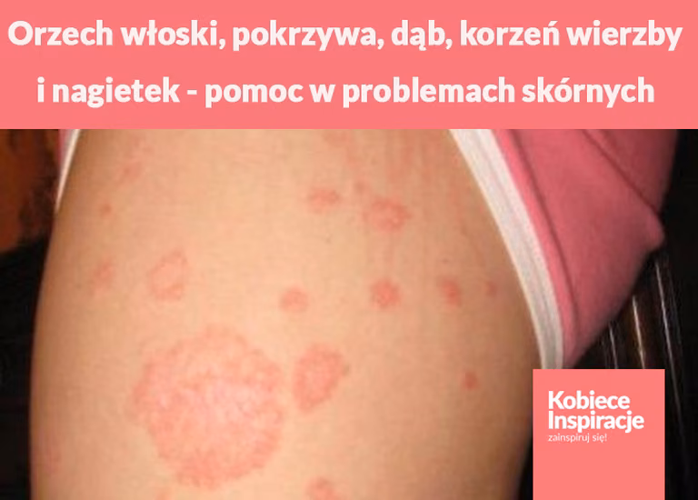 Orzech włoski, pokrzywa, dąb, korzeń wierzby i nagietek - Twoja pomoc w problemach skórnych